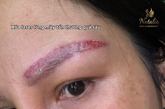 xoa-laser-long-may-bi-do-co-sao-khong (5)